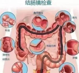 行普通肠镜检查,大多数人还是会有腹痛,腹胀等不适,程度因人而异.
