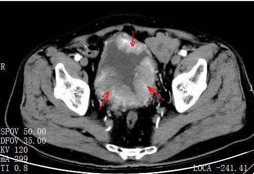 经过增强泌尿系ct,膀胱镜(活检)等检查,确诊为高级别尿路上皮癌,且