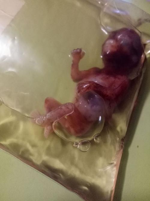 最后给你们看看一个三个月堕胎胎儿的样