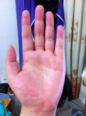 健康的手会呈现红润的状态:如果肝脏出现问题,则在手掌大小鱼际出发红