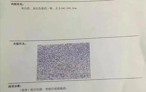 于是在2020年6月重新做了胃镜,并取了活检.病理报告为