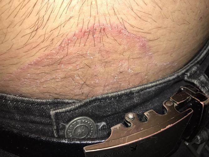 阴囊周围都是这样时不时很痒越抓越痒,什么原因?有什么药可以治好?