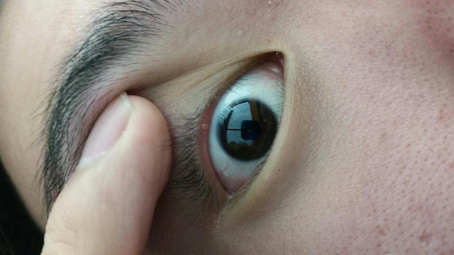 眼睫毛下面长了一个泡,这个是什么东西,严重吗?