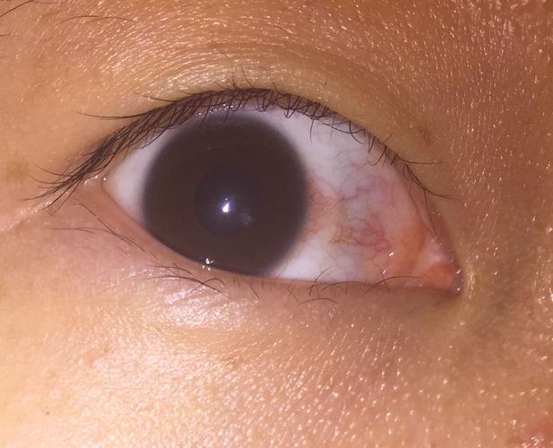 我这是用眼过度还是角膜炎?(平时偶尔有戴隐形眼镜)