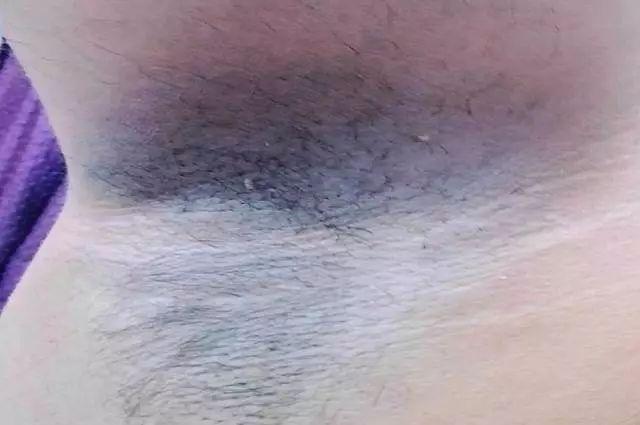 右腋下天鹅绒状色素沉着