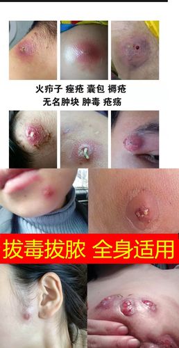 治火疖子屁股坐板疮肿硬块祛q火疖子浓疮包毛囊拔毒