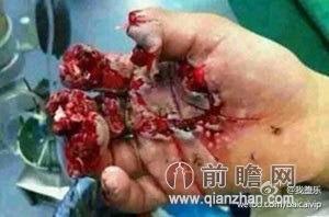 称伊宁一名男孩充电时玩手机发生爆炸,造成整个手掌被炸烂,从照片