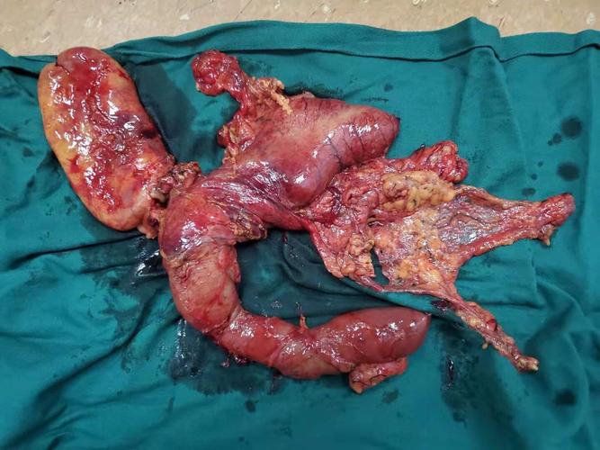 历时5个小时,严秋亮,刘栋,李松团队成功行胰十二指肠切除术,患者安返