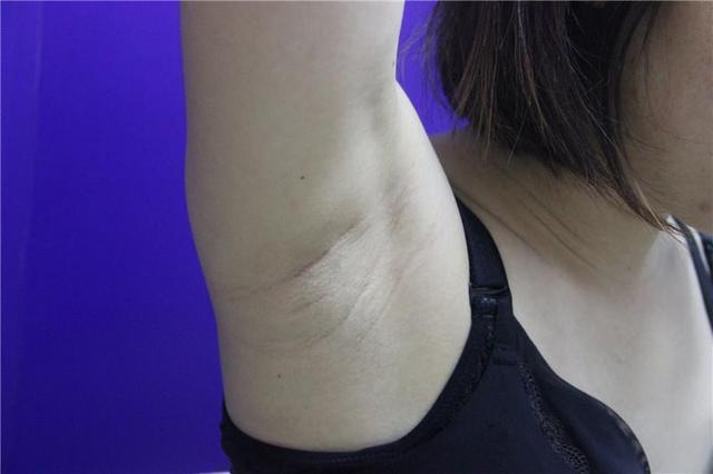 女生腋下毛发旺盛很苦恼可以拔掉吗怎样健康有效的去除腋毛
