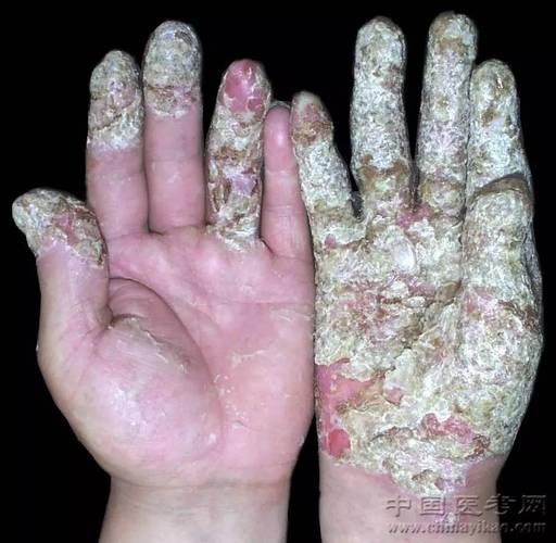 上肢可变性红斑角化症(放大图像)