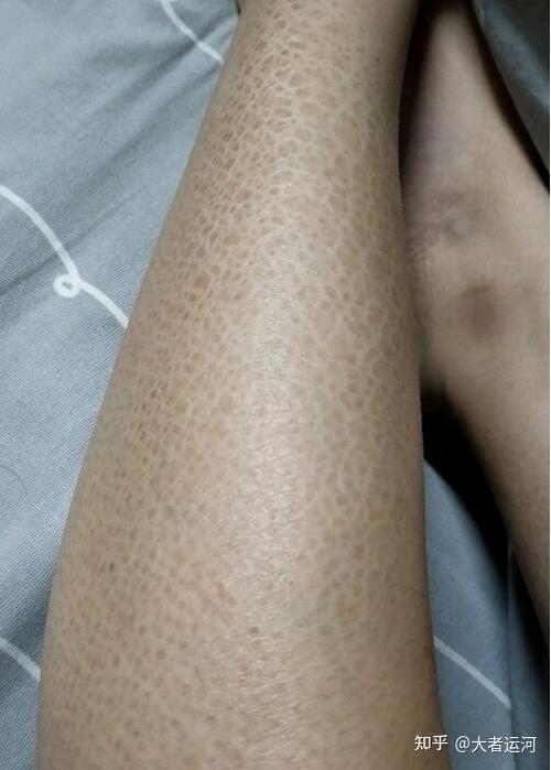 蛇皮肤该怎么去除