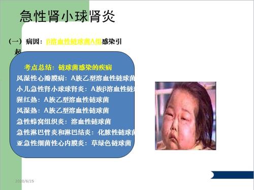 肾小球肾炎病人的护理查房ppt