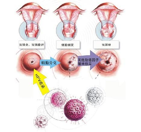 宫颈癌化疗后小腿酸痛怎么办?
