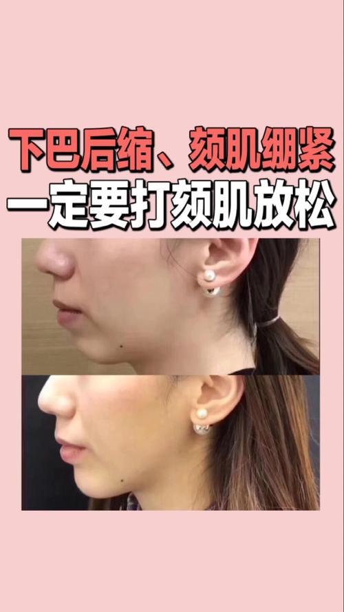 颏肌放松