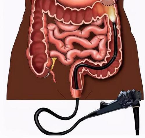 肠镜可有效查处90%以上结直肠病变,探头还能收集到腹腔内其他部位病变