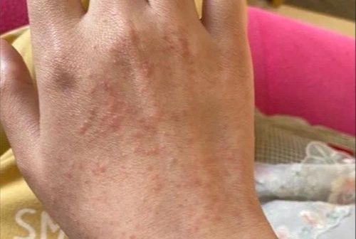 光过敏多形性日光疹