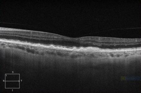 小心老年人的"视力杀手"—老年性黄斑变性!