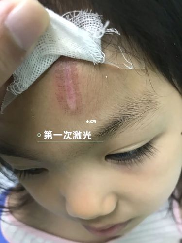 儿童激光除疤_除疤_祛疤_去疤_美妆_医美整形