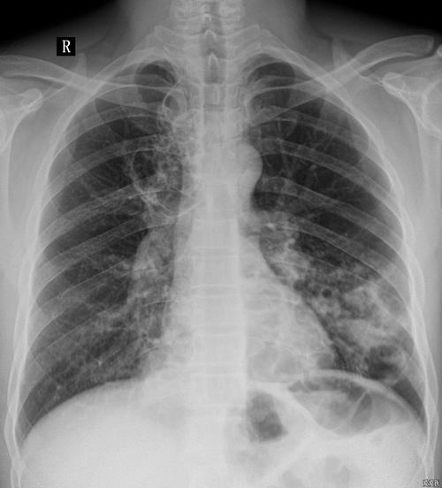 胸部正位dr片双肺多发透亮影