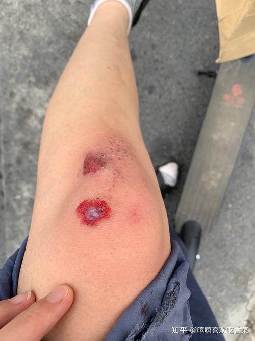 膝盖磕破 已经结痂,但是走路的时候有点疼,请问有人知道怎么回事吗