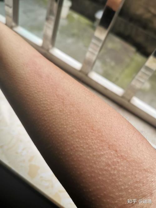 紫外线过敏/日光性皮炎 是一种怎样的感受?