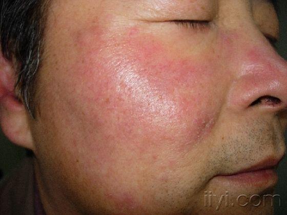 病例讨论26 - 皮肤及性传播疾病讨论版 - 爱爱医医学论坛