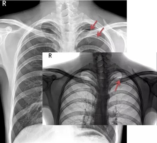 气胸的x线表现,6个病例帮你搞定