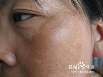 如何去掉脸上的斑点之:黄褐斑