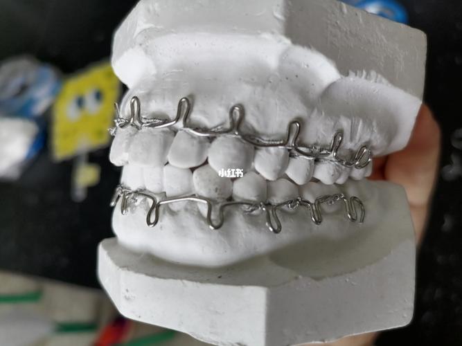 第一次牙弓夹板制作圆满完成!撒花撒花~_夹板_医学生