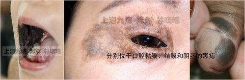 黑色素痣痣关重要的诊疗常识多图详解