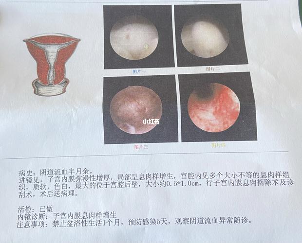 记录第一次手术 宫腔镜 内膜息肉_子宫_15分钟_孕酮_怀孕_备孕_医疗