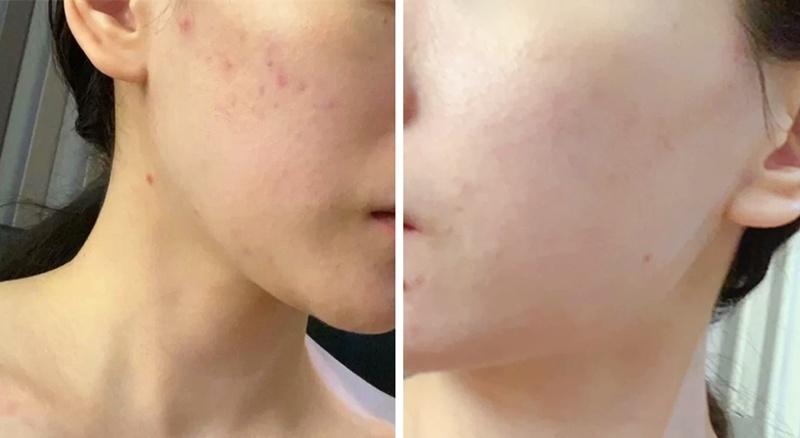 如何有效淡化脸上的痘印?