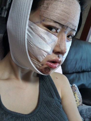 手术后第二周,取下绷带后已经渐渐的消除了大肿