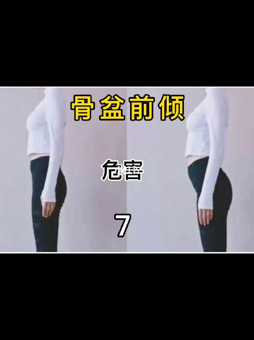 骨盆前倾的危害(五)_骨盆前倾_深圳市龙岗区人民医院攻略_运动康复