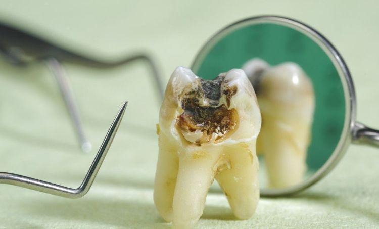 虫牙已经开始疼了补牙还有吗