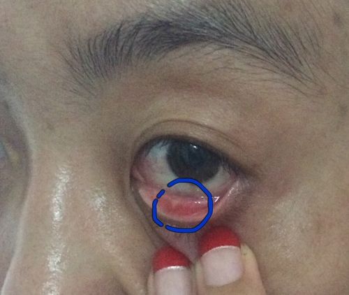 下眼皮上长了这么个白点,有没有眼科大夫,这是个长了个什么呀?有按