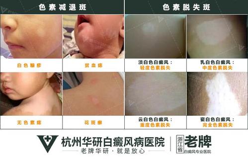 春季不明白斑?杭州华研白癜风医院开展0元确诊查诱因
