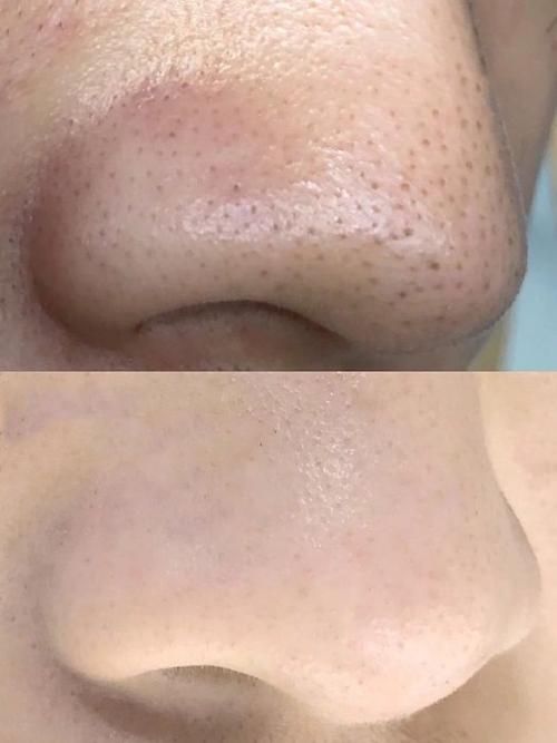 去黑头的鼻膜贴真的有用么