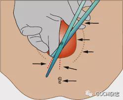 传统助产,会阴侧切,无创助产,三种技术对产妇盆底功能