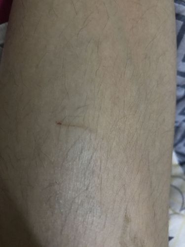 被老鼠抓了下 需要打疫苗吗?轻微抓伤