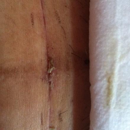 剖腹产第十天伤口好像发炎了!