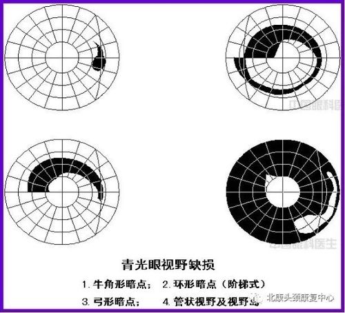 光明的窃贼青光眼