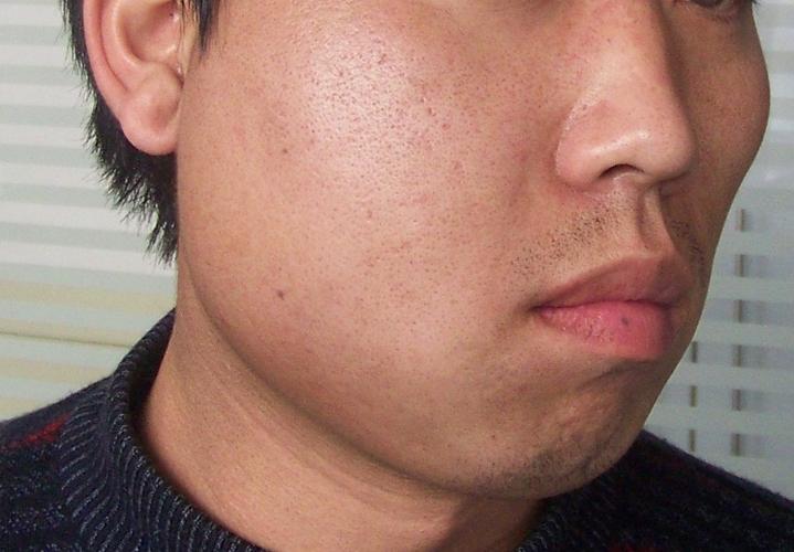 牙源性咬肌间隙感染