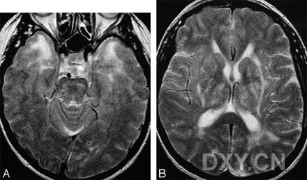 脑白质疏松与眼底血管病变的相关性分析