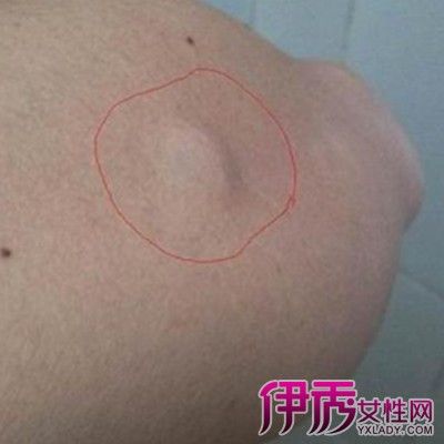 皮下脂肪瘤疼痛原因大揭秘