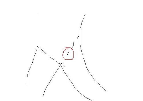 大腿根部有类似淋巴结的症状