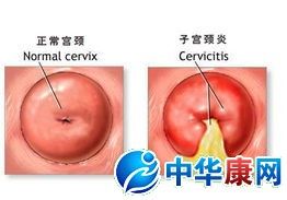 宫颈炎图片