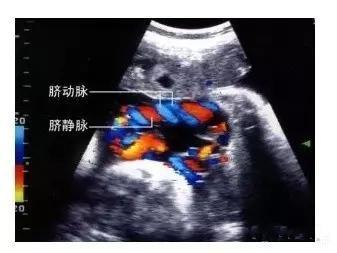 宝宝呵护 脐带是怎么形成的 一根神奇的带子关系宝宝的性命   脐动脉