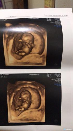 [试管婴儿]宝贝已经11周了,这是10周的