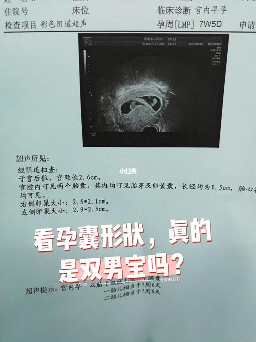 孕囊形状真的是双男宝吗?_孕期_女宝_孕期日常_母婴